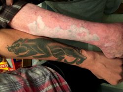 Laser tattoo removal