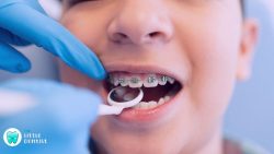 Braces for Kids in Delhi | TheLittleDentist