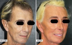 Facial Feminization Surgery Results