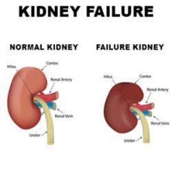 Kidney failure treatment in ayurveda