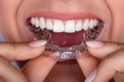 Invisalign Retainer Cost | Invisible Clear Trays | Invisible Retainer Cost