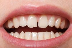 Fixing Gap Teeth Braces Options | Braces for Teeth Gap