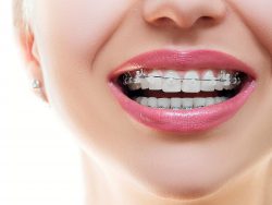 Overbite Before And After Braces | Normal Overbite | Overbite After Braces