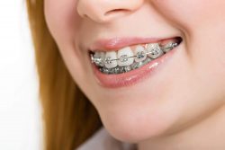 Children’s Orthodontist Near Me | Tips From Orthodontist In Aventura, FL