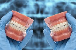 Normal Bite Occlusion | Improper Vs. Normal Teeth Bite