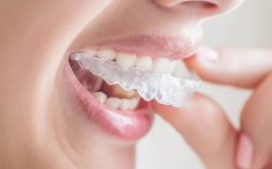 Methods For Overbite Correction | Invisalign and Braces Fix an Overbite