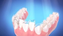 Straight Talk About Adult Braces | Types of Metal Braces sunny isles beach