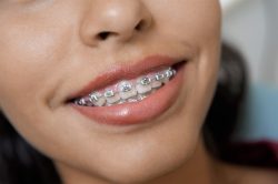 Braces Orthodontist Near Me in Miami | Best Orthodontic Center in Miami