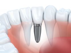 Average Cost of Dental Implants