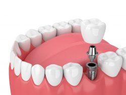 Different Types of Dental Implants