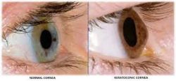 Keratoconus Treatment in Ayurveda