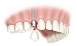 New Smiles: Dentist in Houston | Dental Implants – Urbn Dental