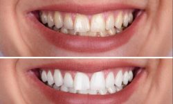 Top Tips on Laser Whitening You Must Know | Teeth Whitening Treatments