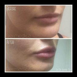 Lip Fillers in Perth