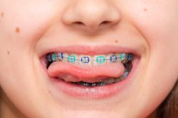 Find Local Orthodontist Near Me For Braces