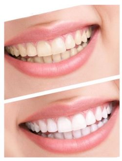 Best Teeth whitening service in Plano