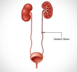 Ureteric Stone Surgery in Delhi