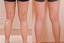 Varicose Veins Treatment in Jaipur