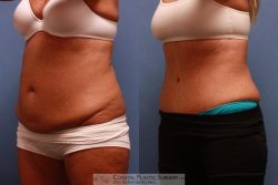 Tummy Tuck Before and After Pictures