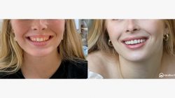 Affordable Dental Implants Near Me