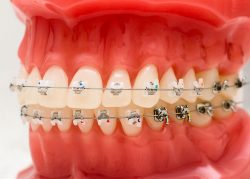 Affordable Dental Braces Near Me