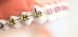 Affordable Dental Braces In Miami, FL