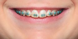 Best Orthodontist Specialists in Hallandale Fl