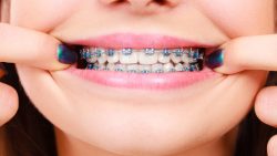 Orthodontist Specialists in Hollywood, Fl