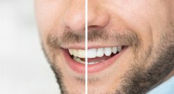 Professional Teeth Whitening Near Me