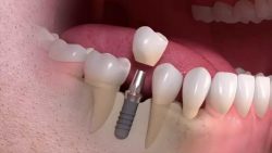 Dental Implants Service in North Miami