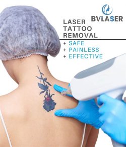 PicoSure laser