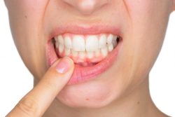 Early Signs and symptoms of gingivitis