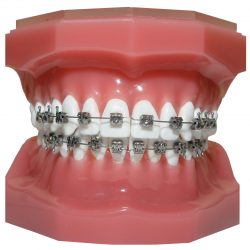 Affordable Dental Braces In Miami, FL