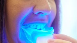 Best Teeth Whitening kit For a Brighter Smile