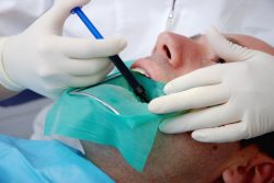 How Long Does a Root Canal Take?