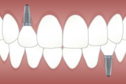 Affordable Dental Implants