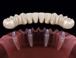 Different Types of Dental Implants