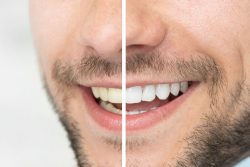 Teeth Whitening Dentist Cost