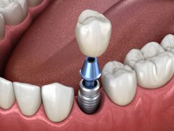 Single Tooth Implants In Houston Heights