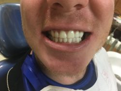 Affordable Porcelain Veneers Near Me