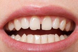 Veneers For Gap Teeth | Fix Front Teeth Gap in Houston, Tx