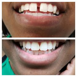 Veneers For Gap Teeth | Fix Front Teeth Gap in Houston, Tx