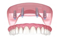 All On 4 Dental Implants Near Me