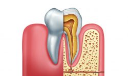 Root Canal Treatment Near Me