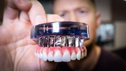 Full Mouth Dental Implants Procedure