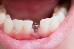 How Long Is the Dental Implant Surgery Recovery?