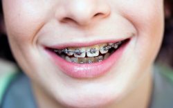 Find Local Braces Dentist Near Me