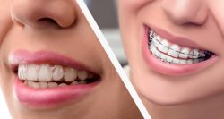 Orthodontic Treatment Options For Adults