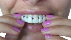 What Are Snap On Veneers?