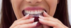 Invisalign North Miami Beach FL